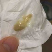 孕期痰好多（孕期痰很多）