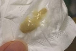 孕期痰好多（孕期痰很多）