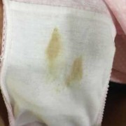 孕期小便发黄怎么回事（我怀孕以后的内裤上总发黄是怎么回事）