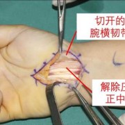 孕妇32周手麻，手疼，手肿。是怎么回事,孕期腕管综合征产后多久恢复正常