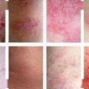 孕妇阴部得了湿疹怎么办,孕期的湿疹怎么办才能好的快