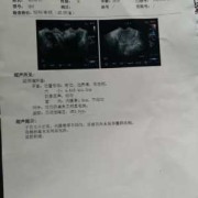 盆腔积液影响胎儿发育吗（盆腔积液影响胎儿发育吗女性）