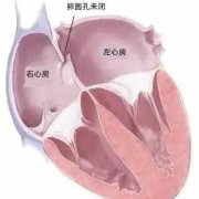 胎儿心脏房间隔卵圆孔（胎儿心脏房间隔卵圆孔3.3 mm）