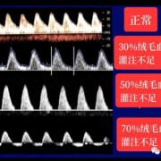 B超单显示单脐动脉是怎么回事,胎儿只有一条脐动脉正常吗