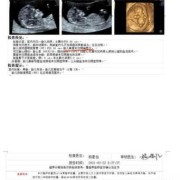 12周胎儿鼻骨显示不清（怀孕产检，nt检查结果看不到鼻骨咋办，胎儿会不会有问题呢）
