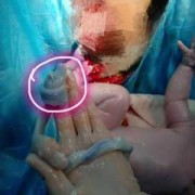 孕5个月单脐动脉胎儿其他都正常,单胎图片 b超