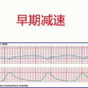 胎儿胎心过慢是什么原因,胎儿胎心减慢,在正常范围