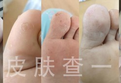 孕期脚气（孕妇得脚气怎么办）