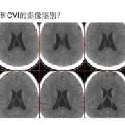 什么是第五第六脑室形成,胎儿第六脑室形成有什么危害