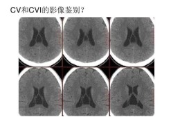 什么是第五第六脑室形成,胎儿第六脑室形成有什么危害