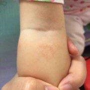 为什么宝宝胳膊腿上总是一块块的跟橘子皮一样的皮,胎儿腿偏短怎么补救