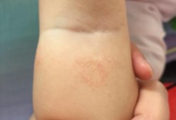 为什么宝宝胳膊腿上总是一块块的跟橘子皮一样的皮,胎儿腿偏短怎么补救