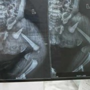 小孩大腿骨折有什么表现,胎儿骨折b超能看出来吗图片