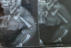 小孩大腿骨折有什么表现,胎儿骨折b超能看出来吗图片