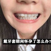 怀孕期间可以戴牙套吗（怀孕期间可以戴牙套吗）