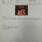 nt的正常范围值是多少,胎儿nt正常值范围