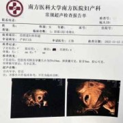 胎儿彩超价格（二维彩超多少钱一次的啊？准备过两天去医院产检的）