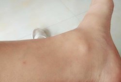 孕期腿肿怎么可以缓解（孕25周左右，腿怎么就有点浮肿了，怎么回事，有什么办法消肿吗）