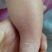 胎儿皮肤增厚（胎儿皮肤增厚）
