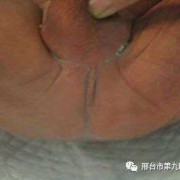 胎儿肛门闭锁孕妇有什么症状,胎儿无肛门是什么原因引起的