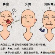 怀孕鼻炎犯了影响胎儿（怀孕鼻炎犯了影响胎儿吗）