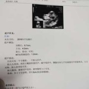 胎儿超声NT（胎儿超声nt值正常范围）