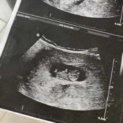 产后恶露38天还没干净怎么办,孕期38天b超能看出孕囊吗