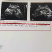 胎儿肾小（胎儿右肾较左肾体积明显缩小，对小孩有无影响）
