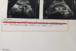 胎儿肾小（胎儿右肾较左肾体积明显缩小，对小孩有无影响）