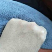 手背上长斑是什么原因,孕期手背长斑怎么回事
