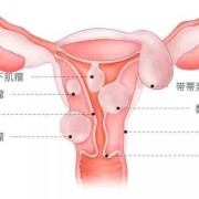 怀孕了子宫肌瘤对胎儿有影响吗（怀孕了子宫肌瘤对胎儿有影响吗,有风险吗?）