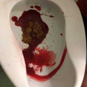 孕期便血怎么办（孕妇便血怎么办，这是什么原因造成呢）