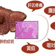 胎儿肝囊肿（胎儿肝囊肿是什么原因引起的）