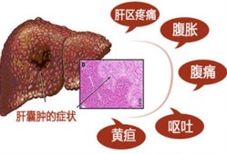 胎儿肝囊肿（胎儿肝囊肿是什么原因引起的）