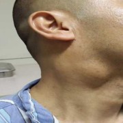 脖子囊肿是什么原因,胎儿颈部有囊肿严重吗怎么办