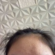 孕期额头长痘（孕期额头长痘）