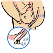 孕期长痔疮影响顺产吗（怀孕有痔疮可以顺产吗）