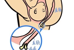 孕期长痔疮影响顺产吗（怀孕有痔疮可以顺产吗）