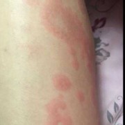 孕期腿部痒（大腿痒是什么原因）