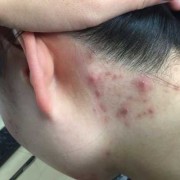耳朵下边长痘是怎么回事,孕期下面长痘痘了还痒怎么办