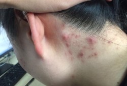 耳朵下边长痘是怎么回事,孕期下面长痘痘了还痒怎么办