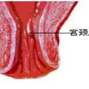 孕妇会有宫颈息肉吗,孕期子宫息肉对胎儿有影响吗
