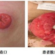 胎儿肛门闭锁孕妇有什么症状（胎儿肛门闭锁孕妇有什么症状）