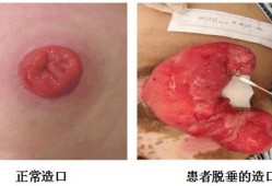 胎儿肛门闭锁孕妇有什么症状（胎儿肛门闭锁孕妇有什么症状）