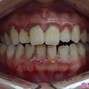 孕妇牙龈发炎怎么办,孕期牙龈炎怎么治疗