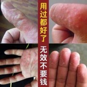 孕妇的脚气怎么治？可以抹什么脚气膏,孕期如何治疗脚气脚臭