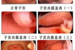 孕妇会有宫颈息肉吗,孕期子宫息肉对胎儿有影响吗