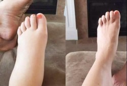 孕妇下肢浮肿的原因，孕期小腿浮肿怎么办,孕期脸浮肿是什么原因引起的