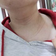 孕期脖子长纹（脖子上一条条纹路是什么）