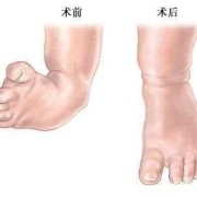 胎儿双足内翻图片（胎儿双足内翻图片大全）